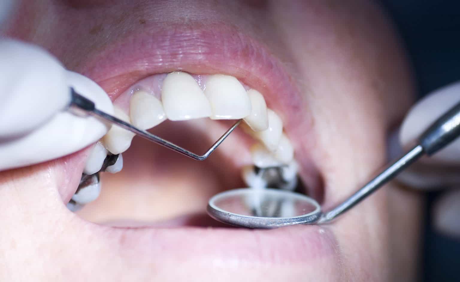 What Are Your Temporary Dental Filling Options? - Dental Aware Australia